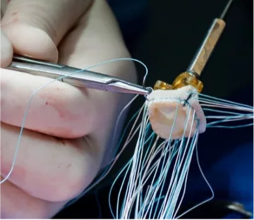 Franco blog aortic valve surgery