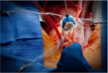 aortic valve surgery aortic valve surgery